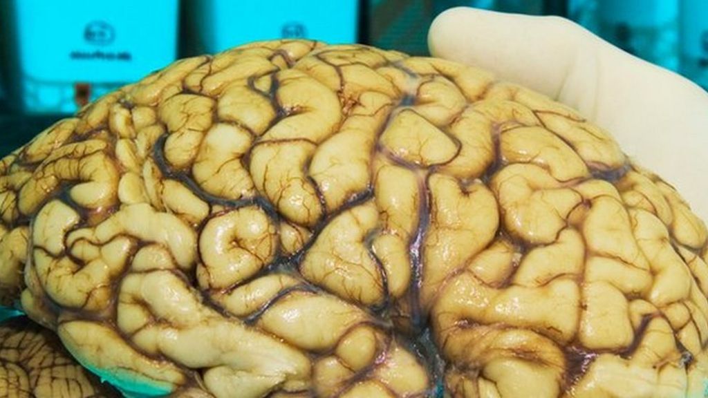 Call for brain donors