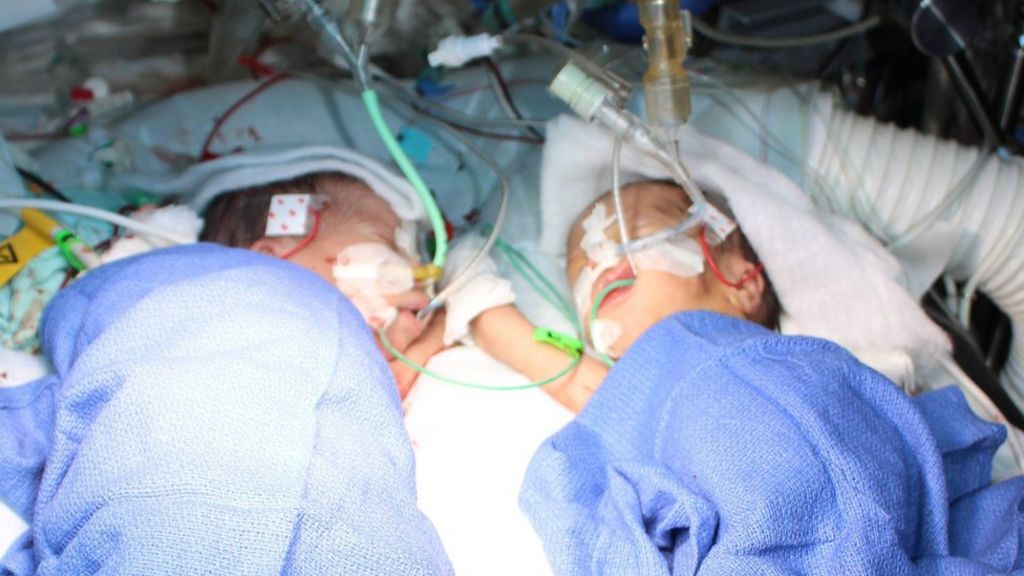 'Youngest' conjoined sisters separated