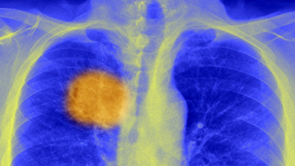 Scientists 'find cancer's Achilles heel'