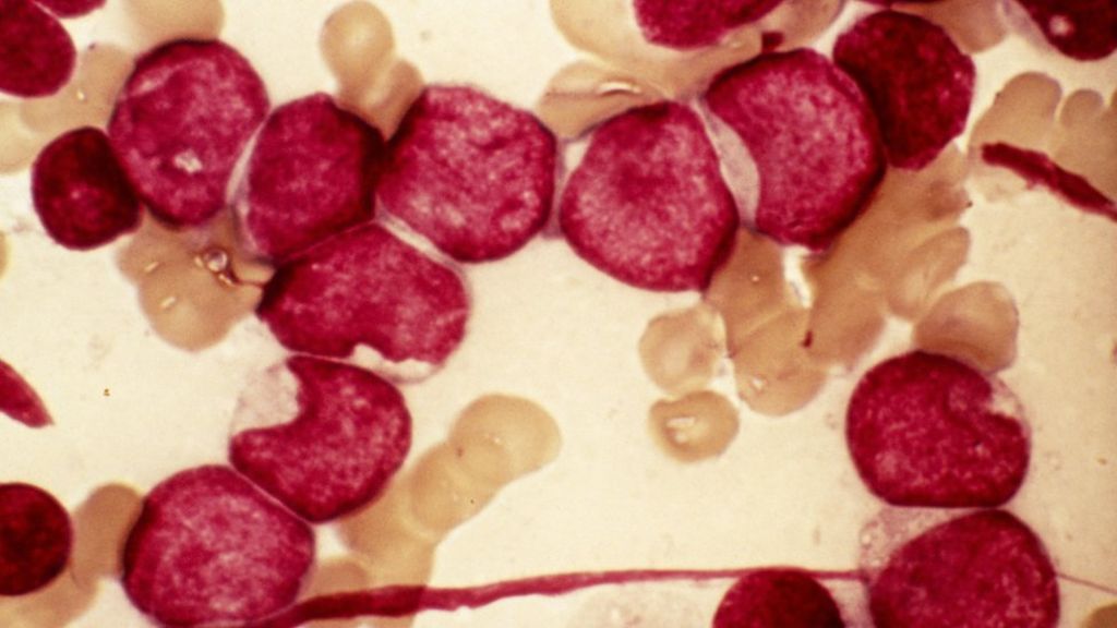 Major blood cancer 'is 11 diseases'