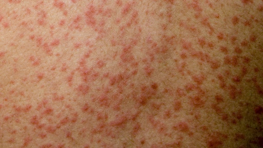 Measles outbreak feared in London and South East BBC News