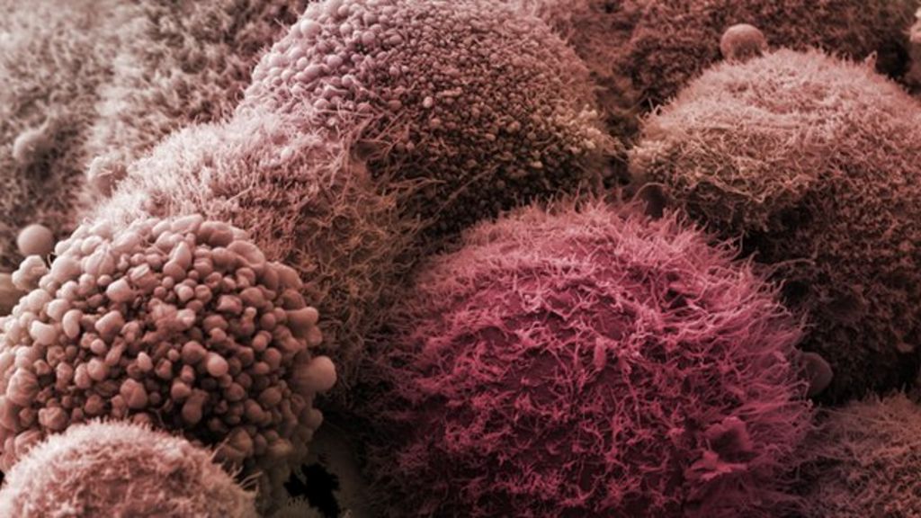 Pancreatic cancer urine test hope