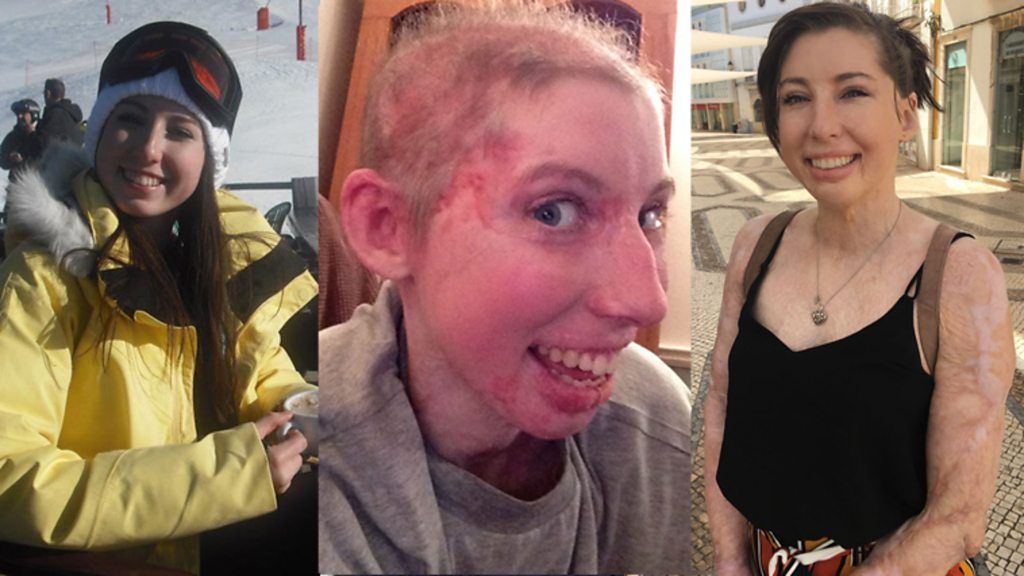 Burns survivor Catrin Pugh: 'I thought I was going to die'