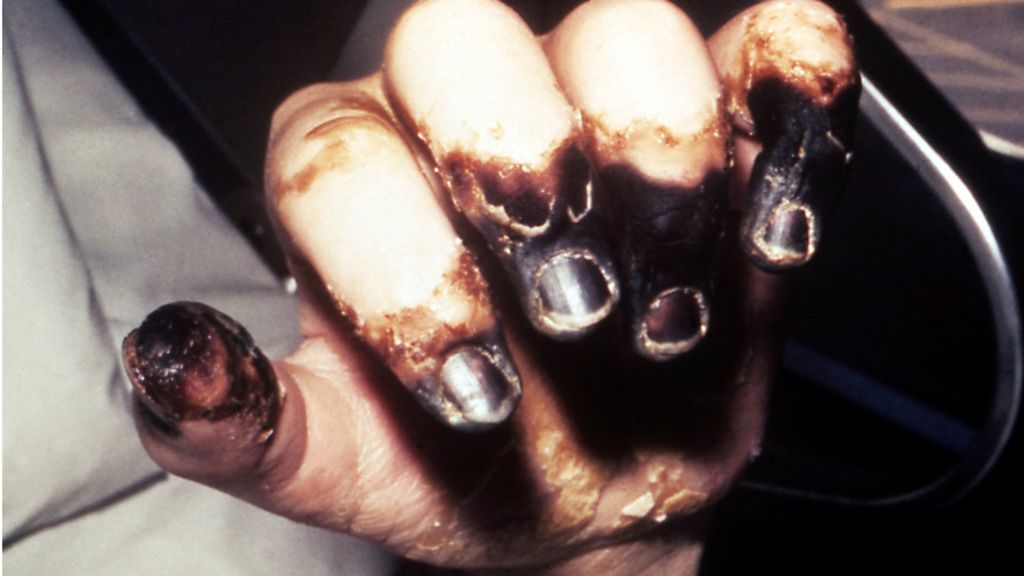 Plague traced back to Bronze Age