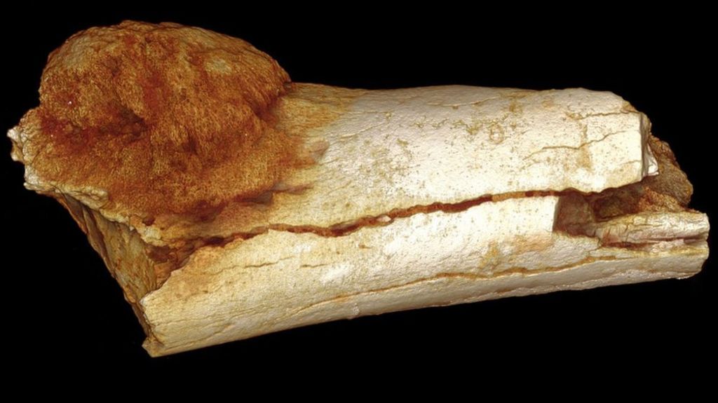 Cancer found in ancient human ancestor's foot
