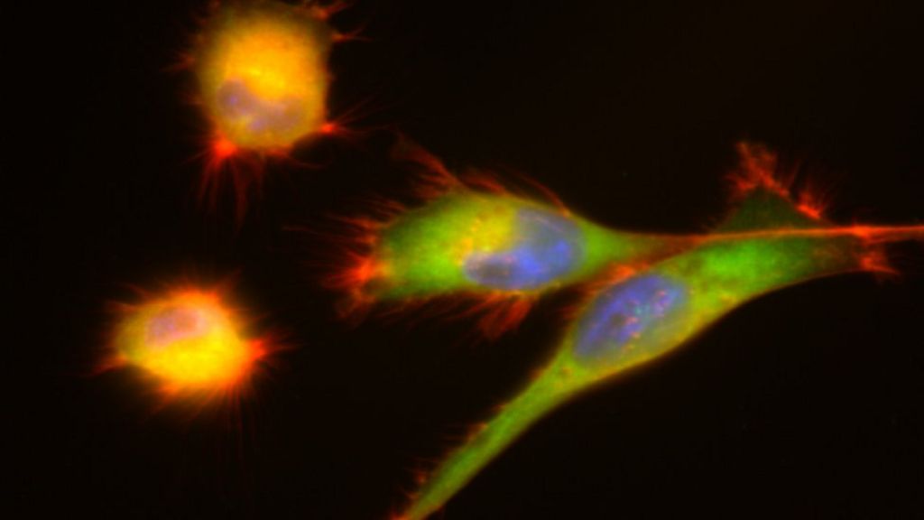 Cell 'stickiness' could indicate cancer spread