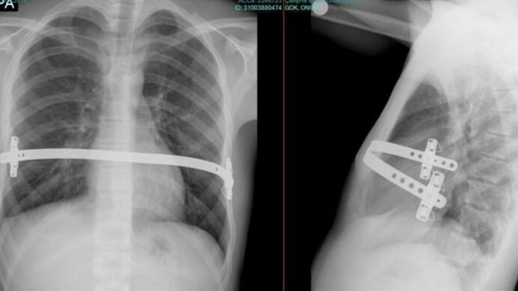 Pioneering chest deformity op carried out at Cardiff hospital BBC News