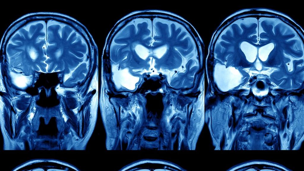 Google DeepMind targets NHS head and neck cancer treatment