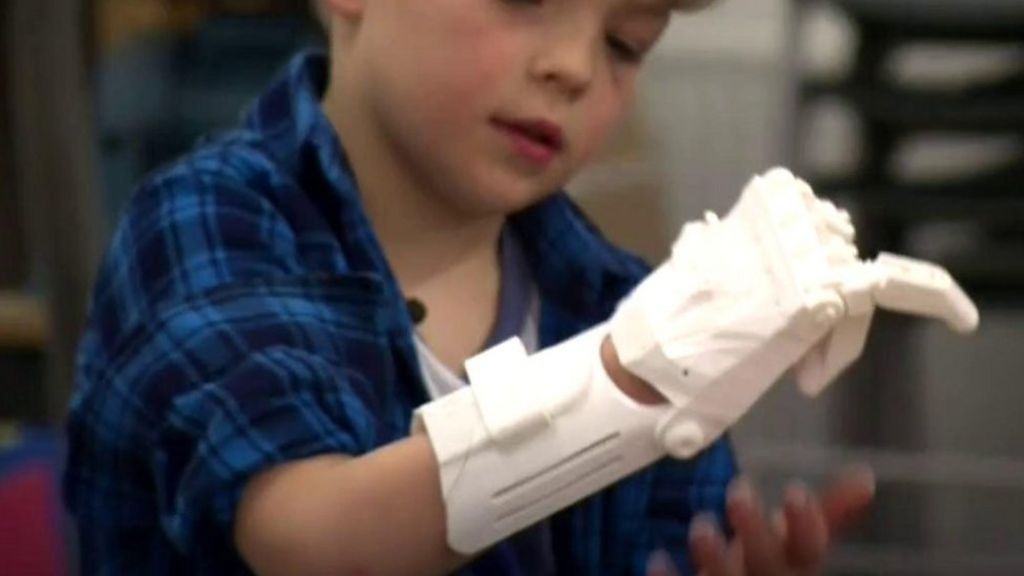 Warrington school makes boy, 5, prosthetic hand