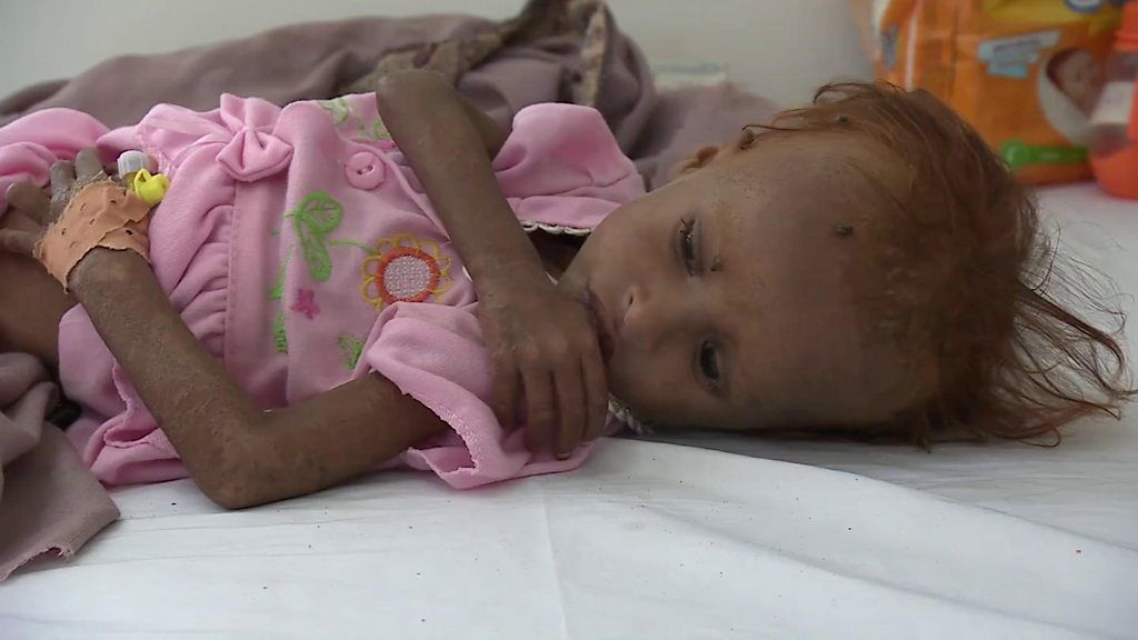 Yemen's war leaves children on the brink of famine