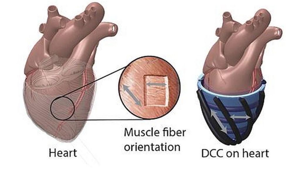 Robotic sleeve 'hugs' failing hearts