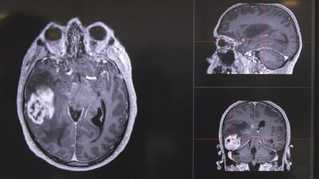 VIDEO: New scan aims to aid tumour detection
