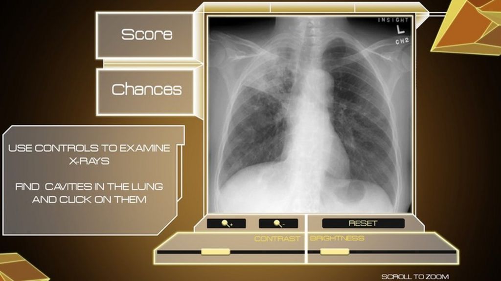 The digital game that could cure TB