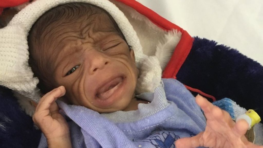 Yemen conflict: UN official accuses world of ignoring crisis