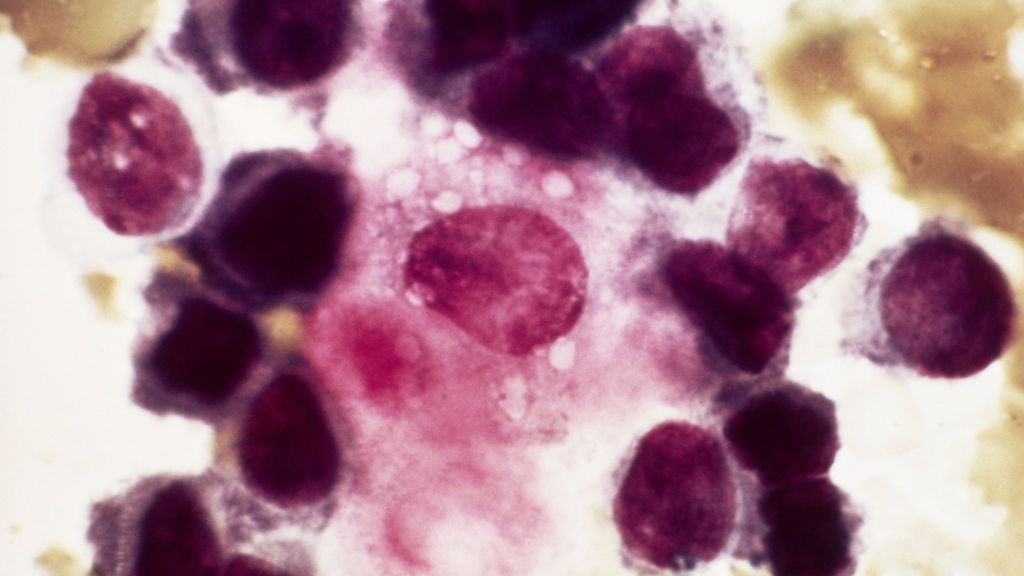 Genetic clue to breast cancer relapses