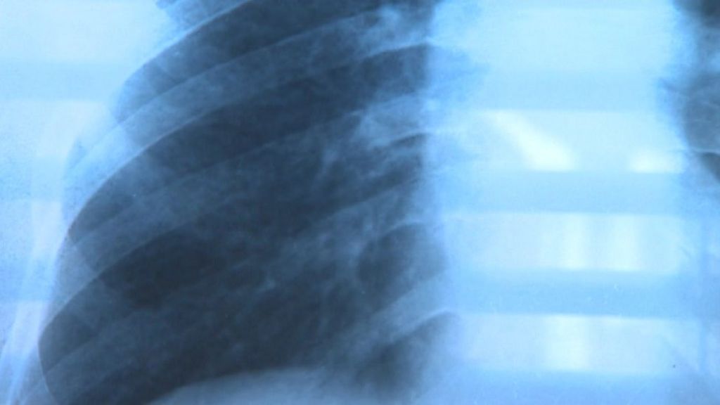 NHS expert to tackle lung scan demand