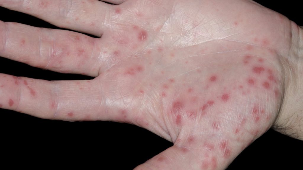 Picture of Hand Foot Mouth Disease on Foot - WebMD