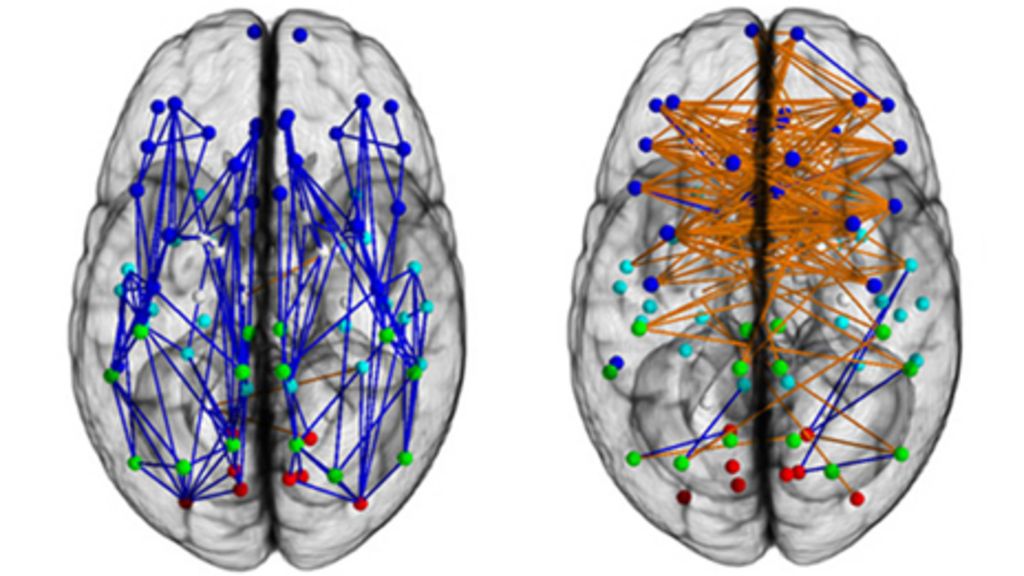 Men And Womens Brains Are Wired Differently Bbc News 