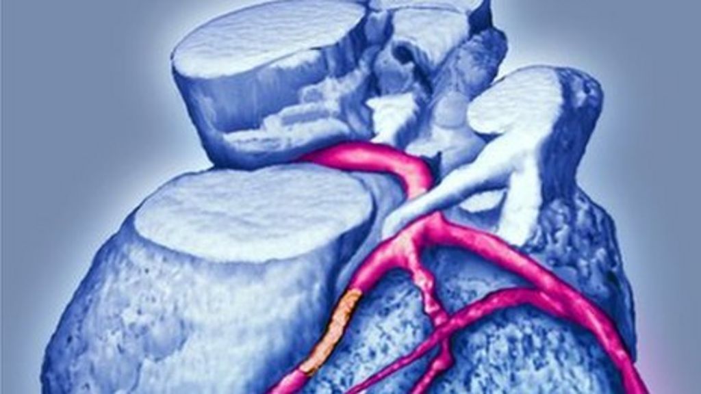 Angioplasty And Its Revolutionary Impact Over 50 Years Bbc News