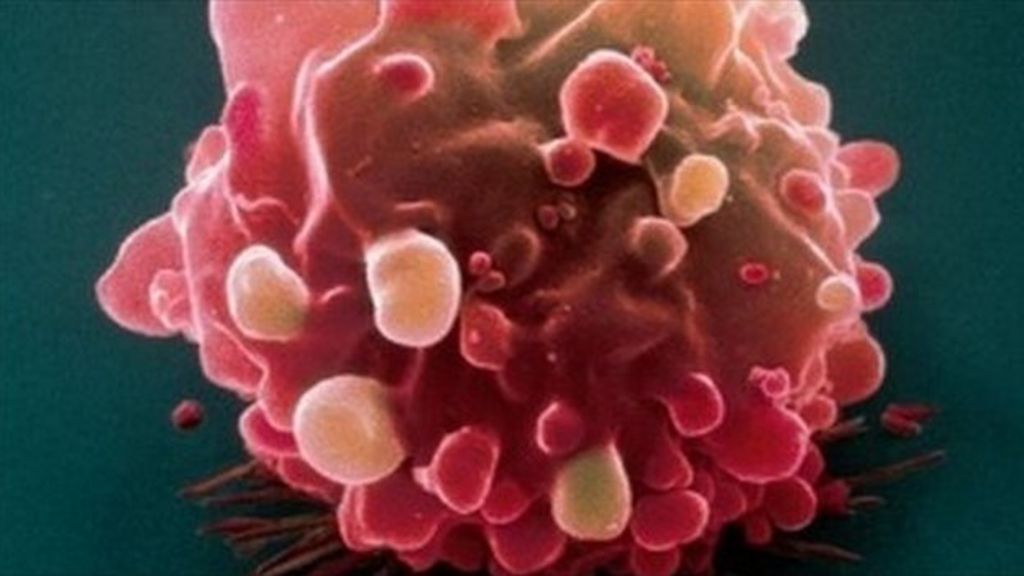 Bowel cancer treatment in Israel Bowel cancer treatment in Israel