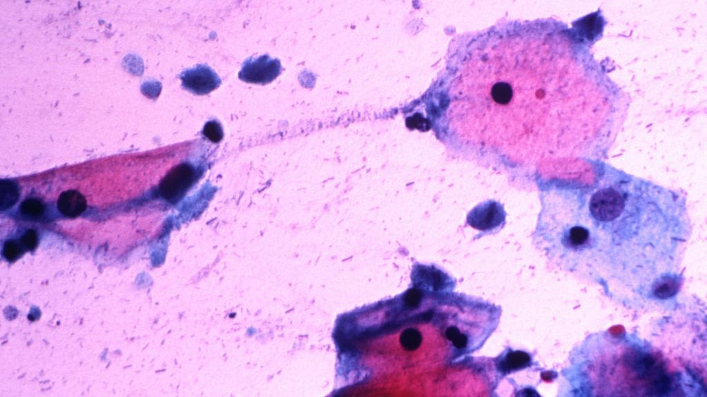 Prostate Cancer May Be A Sexually Transmitted Disease Bbc News