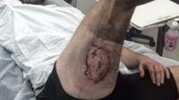 Gareth Clear showing burn on leg