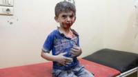 Niño sirio en un hospital de Alepo