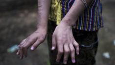 San Kay Khine showing her scarred and damaged hands