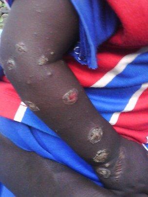 A child's arm shows off circular wounds consistent with chemical poisoning