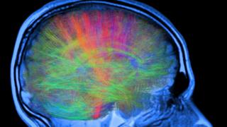 _94956226_c0344686-brain_mri_and_white_matter_fibres-spl _94956226_c0344686-brain_mri_and_white_matter_fibres-spl Million euro prize for cracking brain’s reward system – BBC News 94956226 c0344686 brain mri and white matter fibres spl