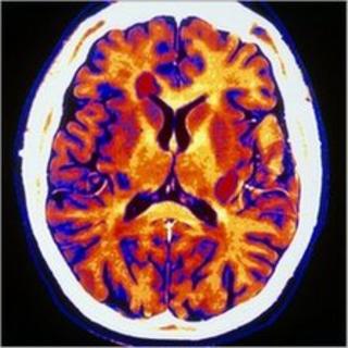 CT scan through the brain of a multiple sclerosis patient