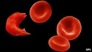 Sickle and normal blood cells