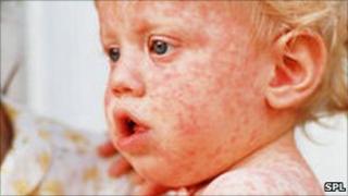 Boy with measles