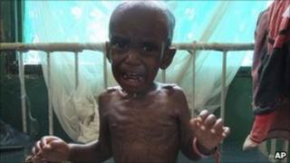 Ali Omar, a three-year-old malnourished child from southern Somalia, at Bandar hospital, Mogadishu, Somalia - 26 July 2011