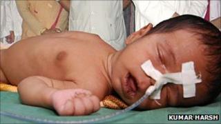 File photo of child suffering from viral encephalitis in a Gorakhpur hospital