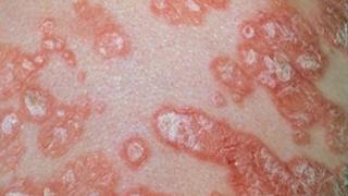 Skin with psoriasis