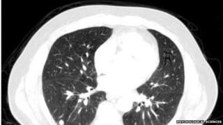 Lung scan