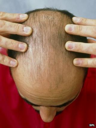 Man with thinning hair