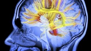 MRI scan of the human brain