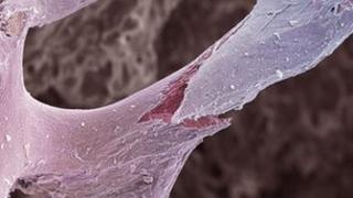 Osteoporotic bone