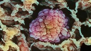 Lung cancer: