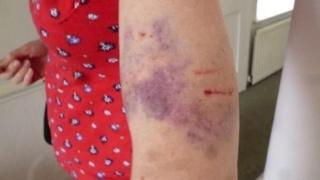 Injury to arm caused by Shiny the cat
