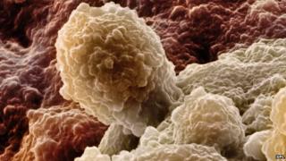 Prostate cancer
