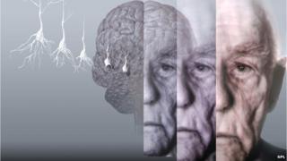dementia