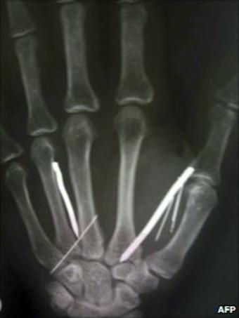 Detail of an X-ray film showing nails in hand of Sri Lankan housemaid