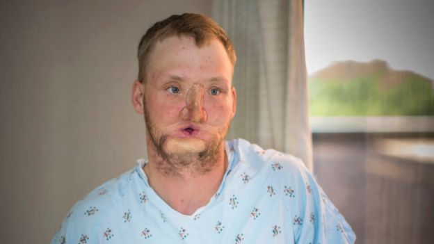 Andy Sandness before his surgery. His face is heavily scarred and his mouth is only an inch wide. He wears a prosthetic nose.