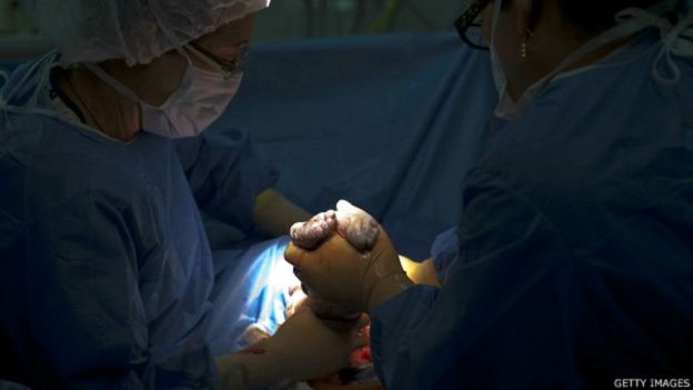 Médicos realizam uma cesárea