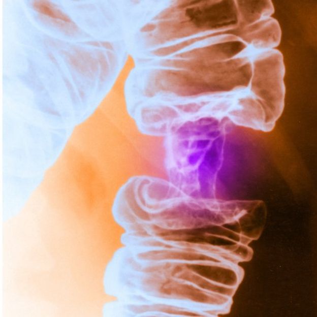 Bowel cancer