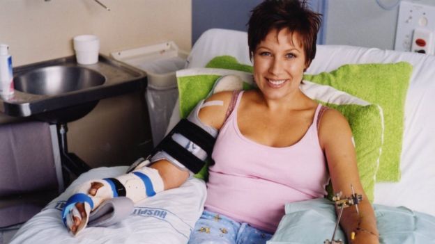 Resultado de imagem para Minhas mãos foram reimplantadas após ataque do namorado com espada de samurai'