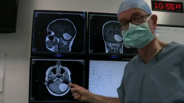 Henry Marsh mostrando el escáner de un tumor cerebral 